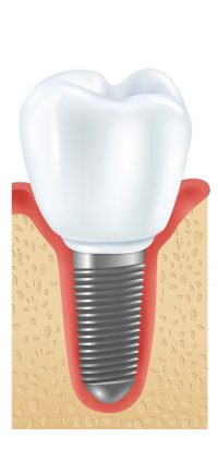 periimplantitis-01